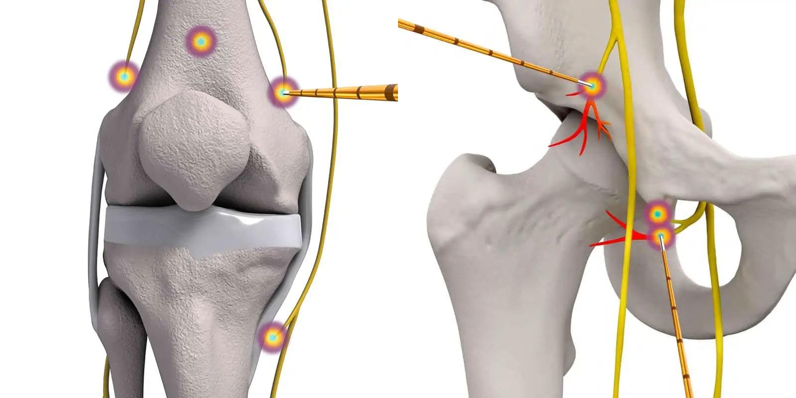 Radiofrequency Rhizotomy – Neurotomy knee and hip